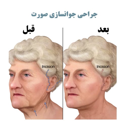 جوانسازی صورت و گردن